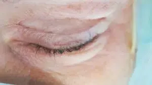 6_auge-nach-straffung-vor-naht Auge nach Straffung vor Naht