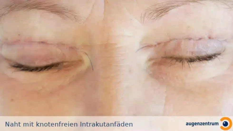 Wie läuft eine Lidstraffung OP ab? Slideshow mit OP Bildern.